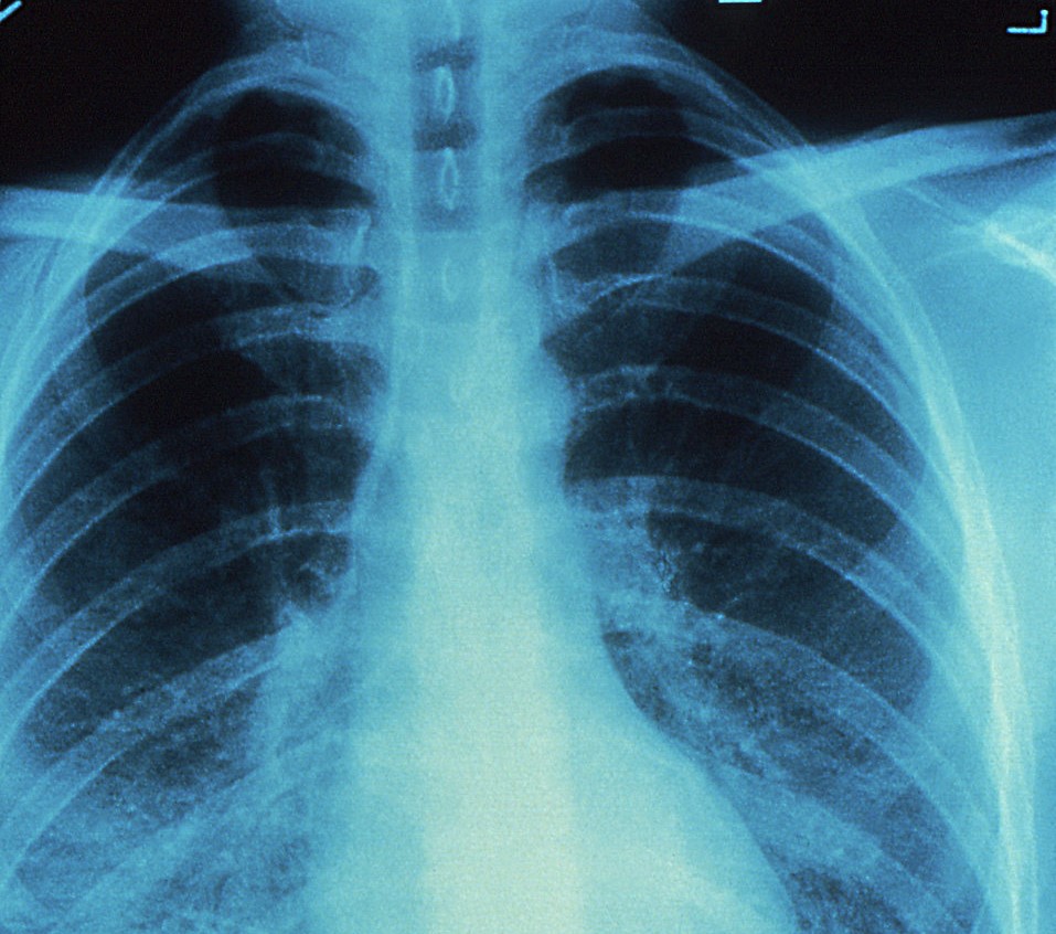 chest x-ray needed as evidence by brachial neuritis lawyer